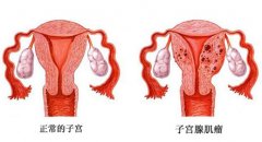 子宫腺肌症试管前需要做治疗吗？如何提高