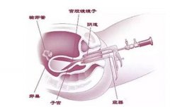 上海助孕公司：冻胚移植前做宫腔镜有哪些