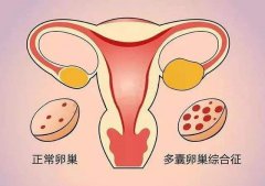 多囊卵巢综合症可以做试管婴儿吗？做试