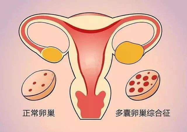 多囊卵巢综合症做试管婴儿的成功率有多大?